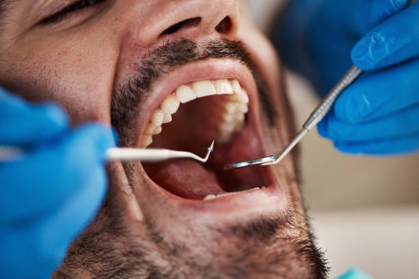 Best Emergency Root Canal Treatment in Layhill, MD